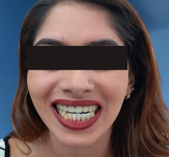 Smile Design Before