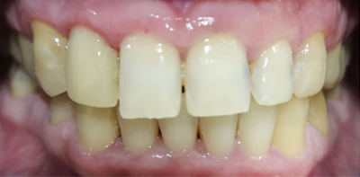Teeth Whitening After