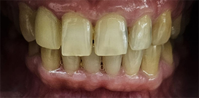 Teeth Whitening Before