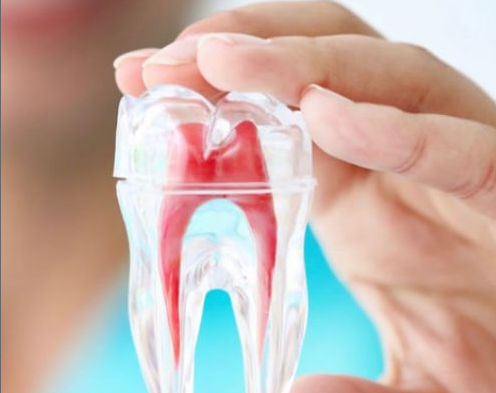 root canal